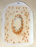 ｜コッホが描いた結核菌の巨大細胞